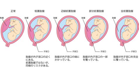 低位胎盤|低置胎盤について